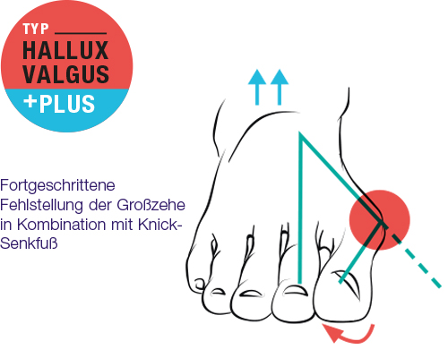 Hallux Valgus Plus - Fehlstellung der Großzehe in Kombination mit Knick-Senkfuß