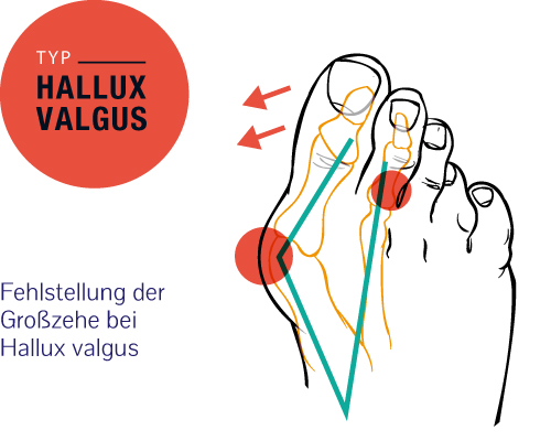 Hallux Valgus - Fehlstellung der Großzehe