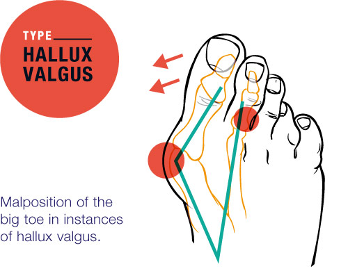 Hallux Valgus - Fehlstellung der Großzehe