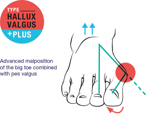 Hallux Valgus Plus - Fehlstellung der Großzehe in Kombination mit Knick-Senkfuß