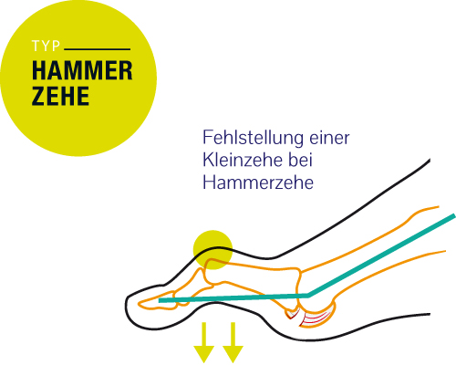 Hammerzehe - Fehlstellung einer Kleinzehe