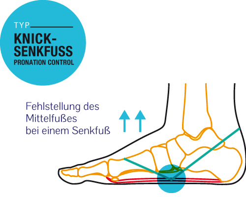 Knick-Senkfuss - Fehlstellung des Mittelfußes