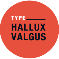 Typ Hallux Valgus